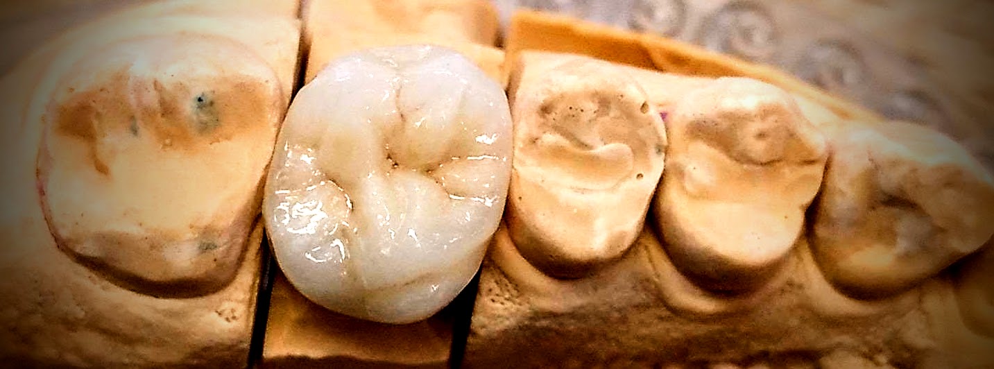 Detalle de una corona cerámica de DNM sobre un modelo