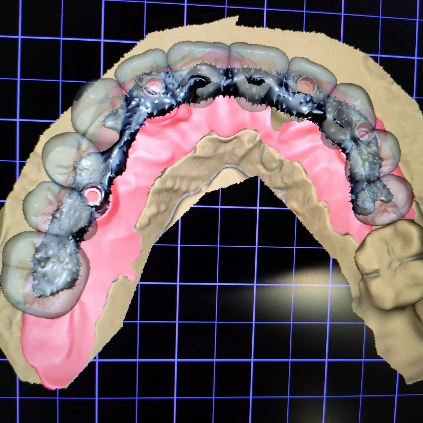 Diseño de una restauración sobre implantes superpuesto al modelo digital en el software del laboratorio
