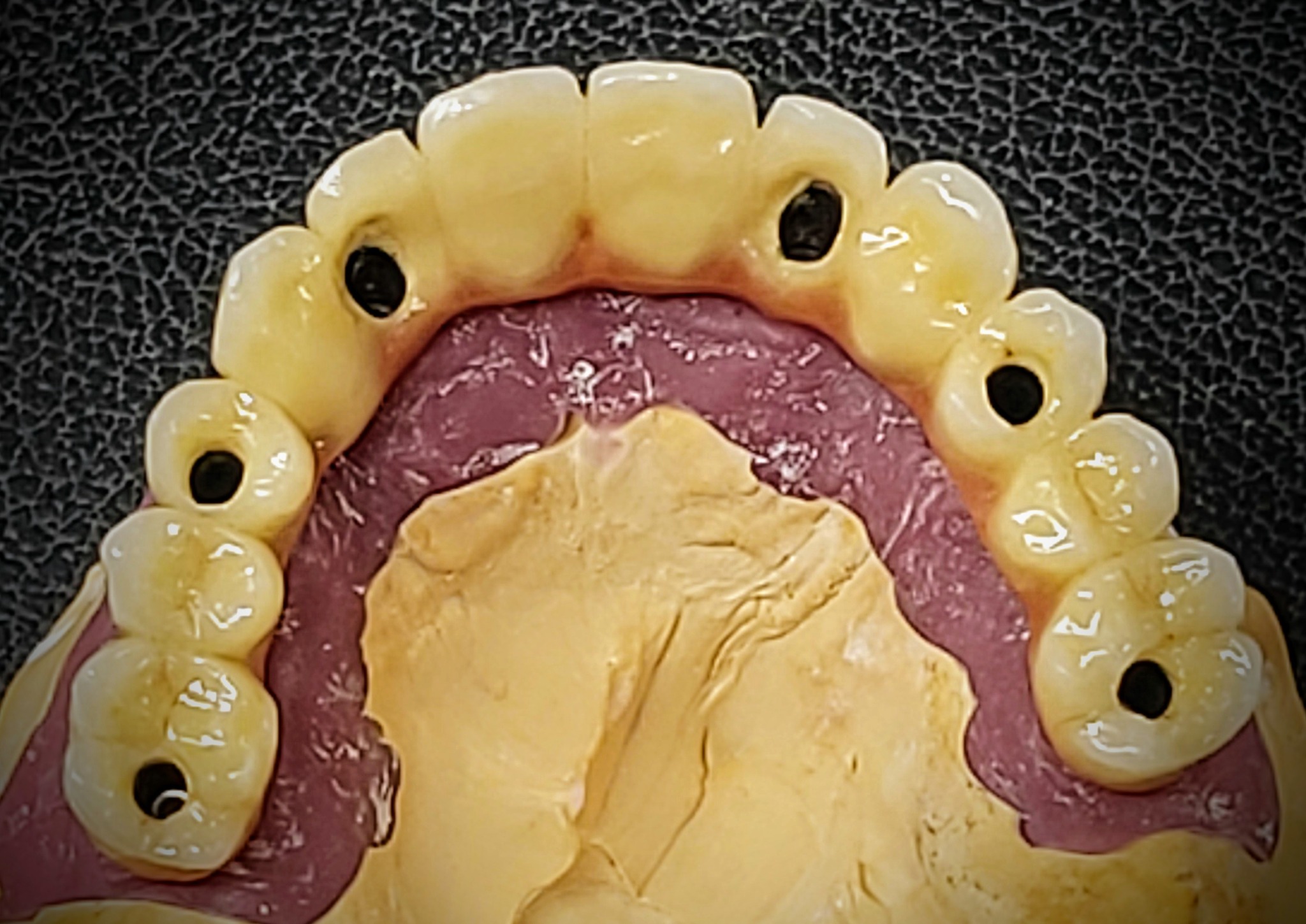 Vista oclusal de una prótesis atornillada de DNM sobre modelo