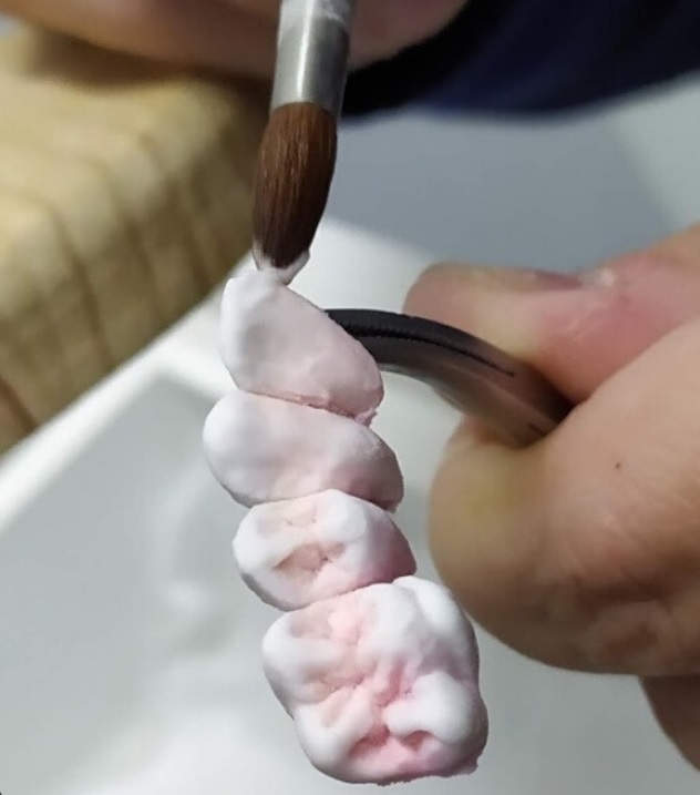 Aplicación manual de cerámica con pincel en una restauración de DNM