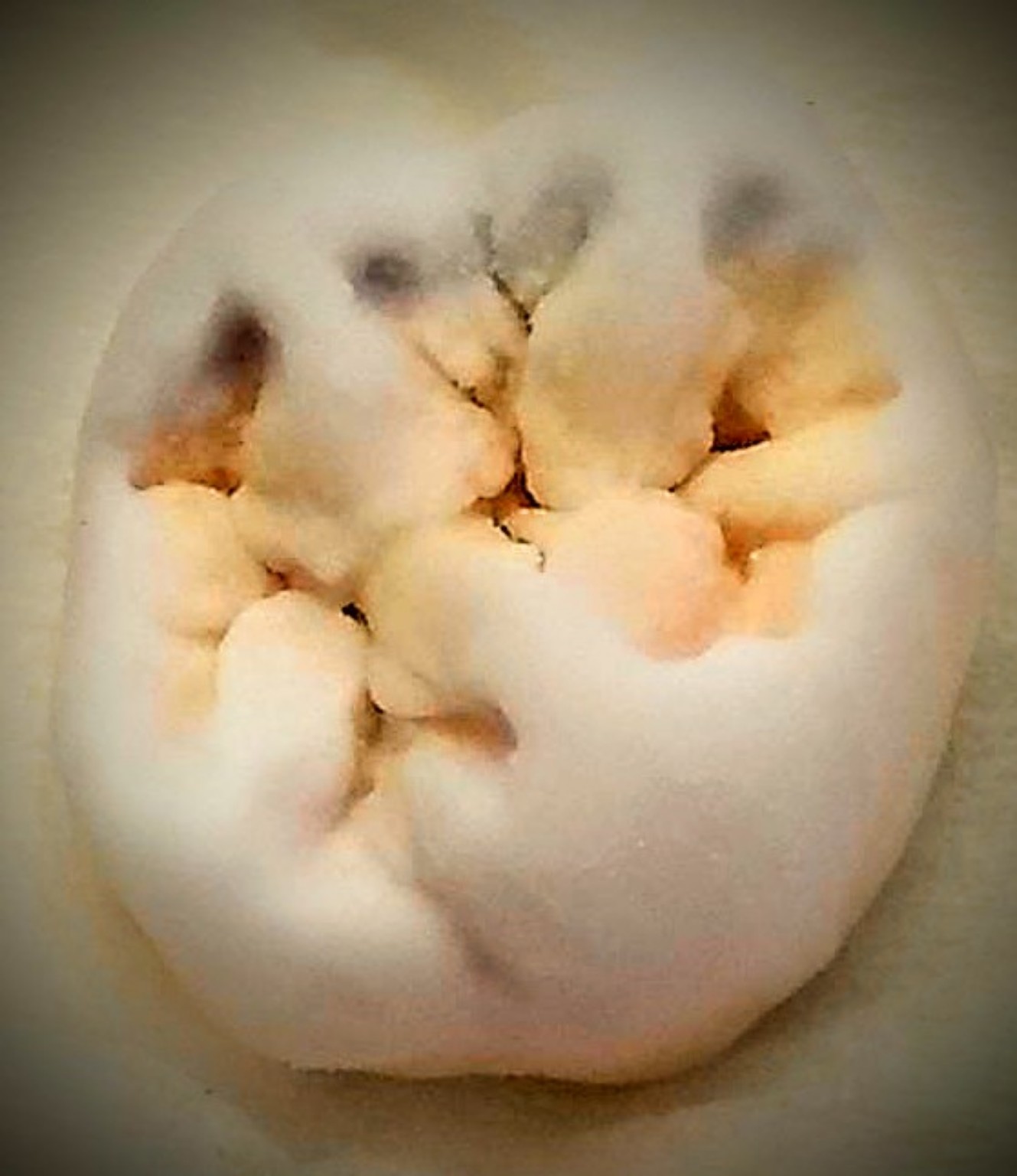 Detalle de la carga cerámica de un molar de DNM para la primera cocción